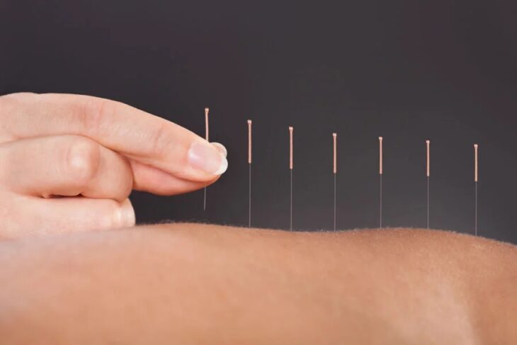 A close-up image of a hand applying acupuncture needles to a person's arm. The hand is of light skin tone and has manicured nails. The arm is also of light skin tone, showcasing several fine acupuncture needles inserted along the skin.